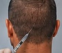 Anestesia y preparación